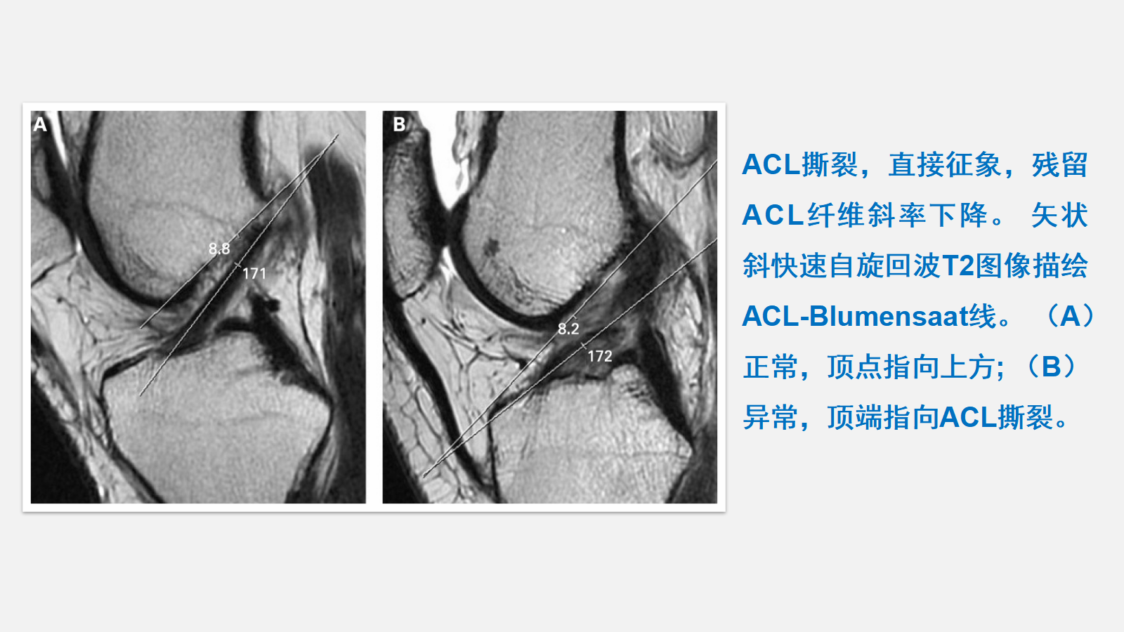 前交叉韧带（ACL）损伤的MRI诊断技巧，详细解析！