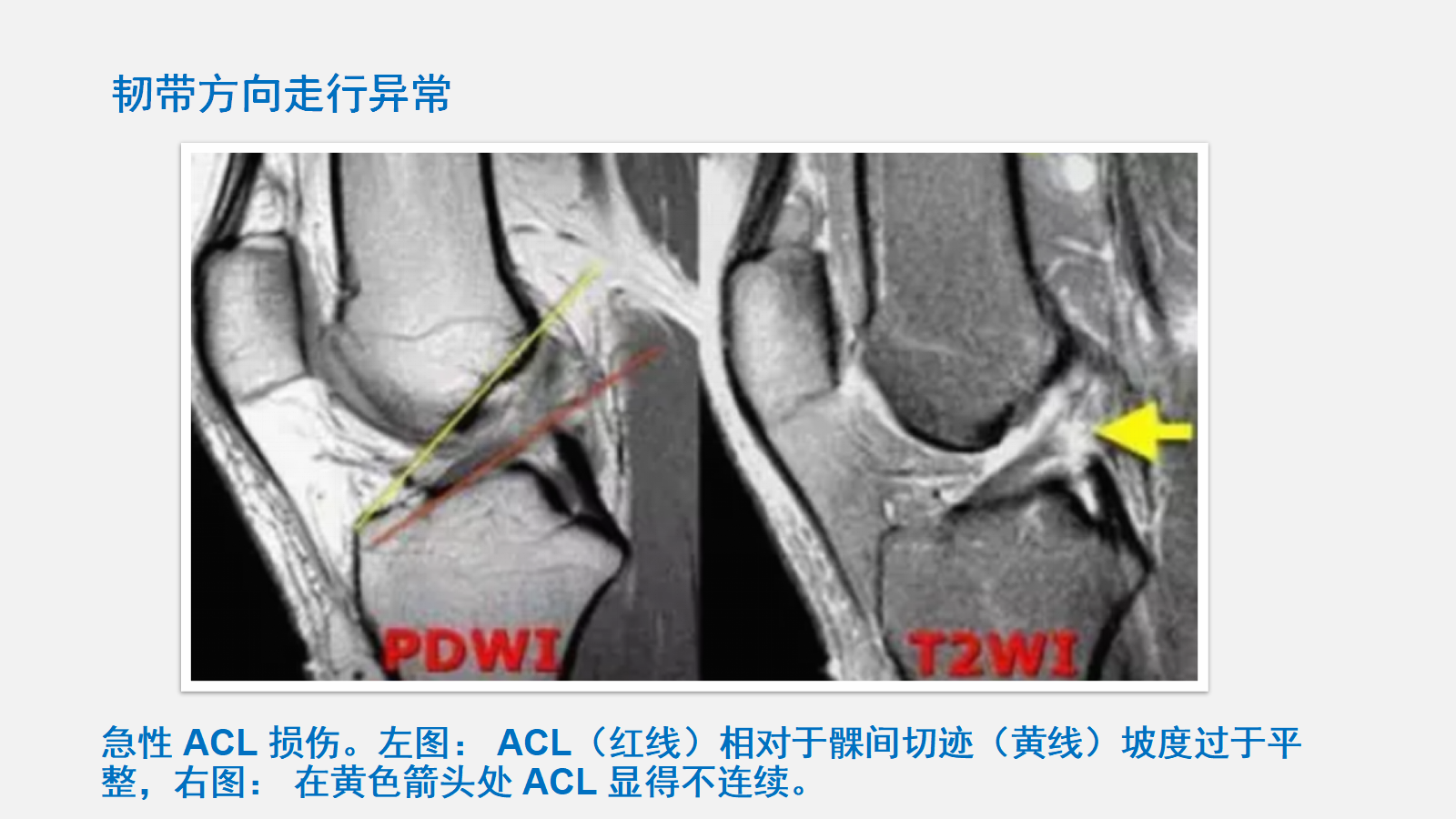 前交叉韧带（ACL）损伤的MRI诊断技巧，详细解析！