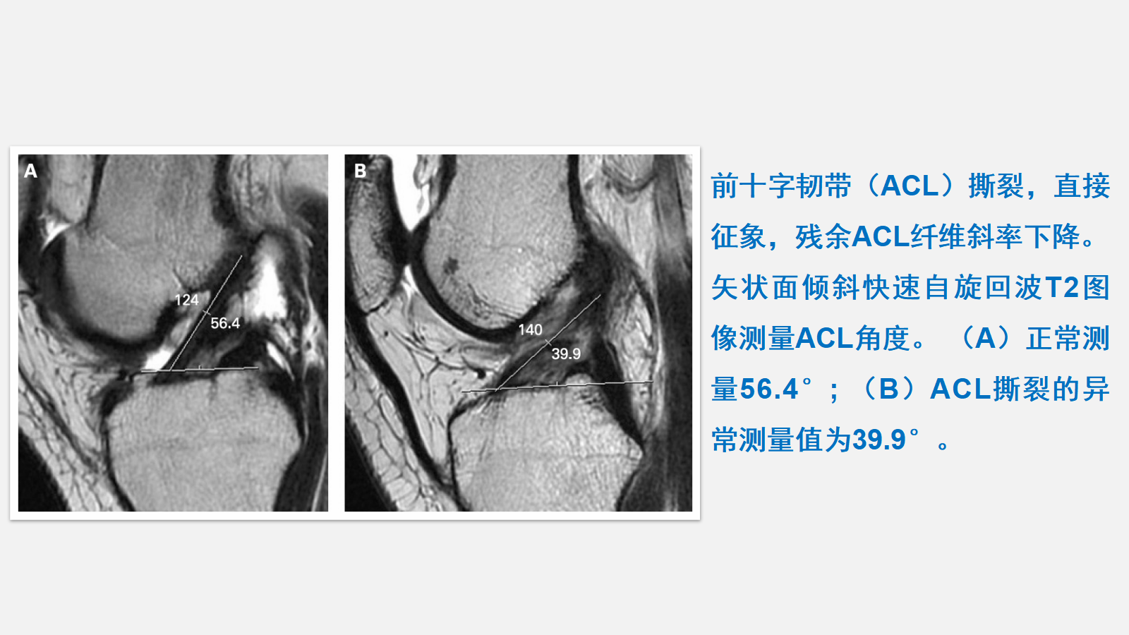 前交叉韧带（ACL）损伤的MRI诊断技巧，详细解析！