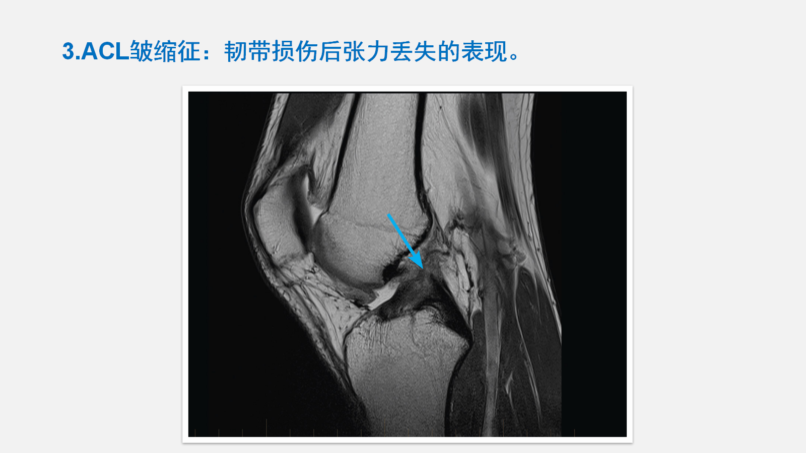 前交叉韧带（ACL）损伤的MRI诊断技巧，详细解析！