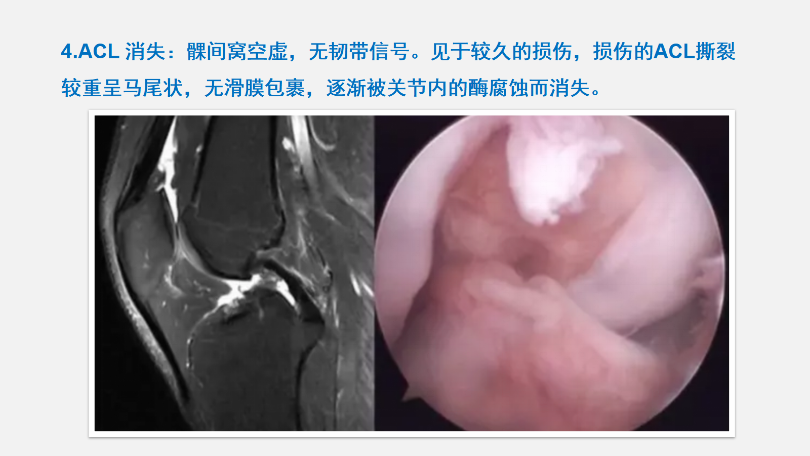 前交叉韧带（ACL）损伤的MRI诊断技巧，详细解析！