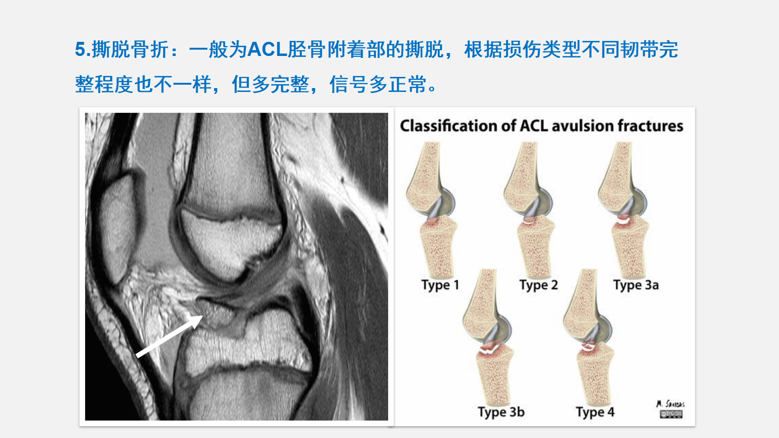 前交叉韧带（ACL）损伤的MRI诊断技巧，详细解析！