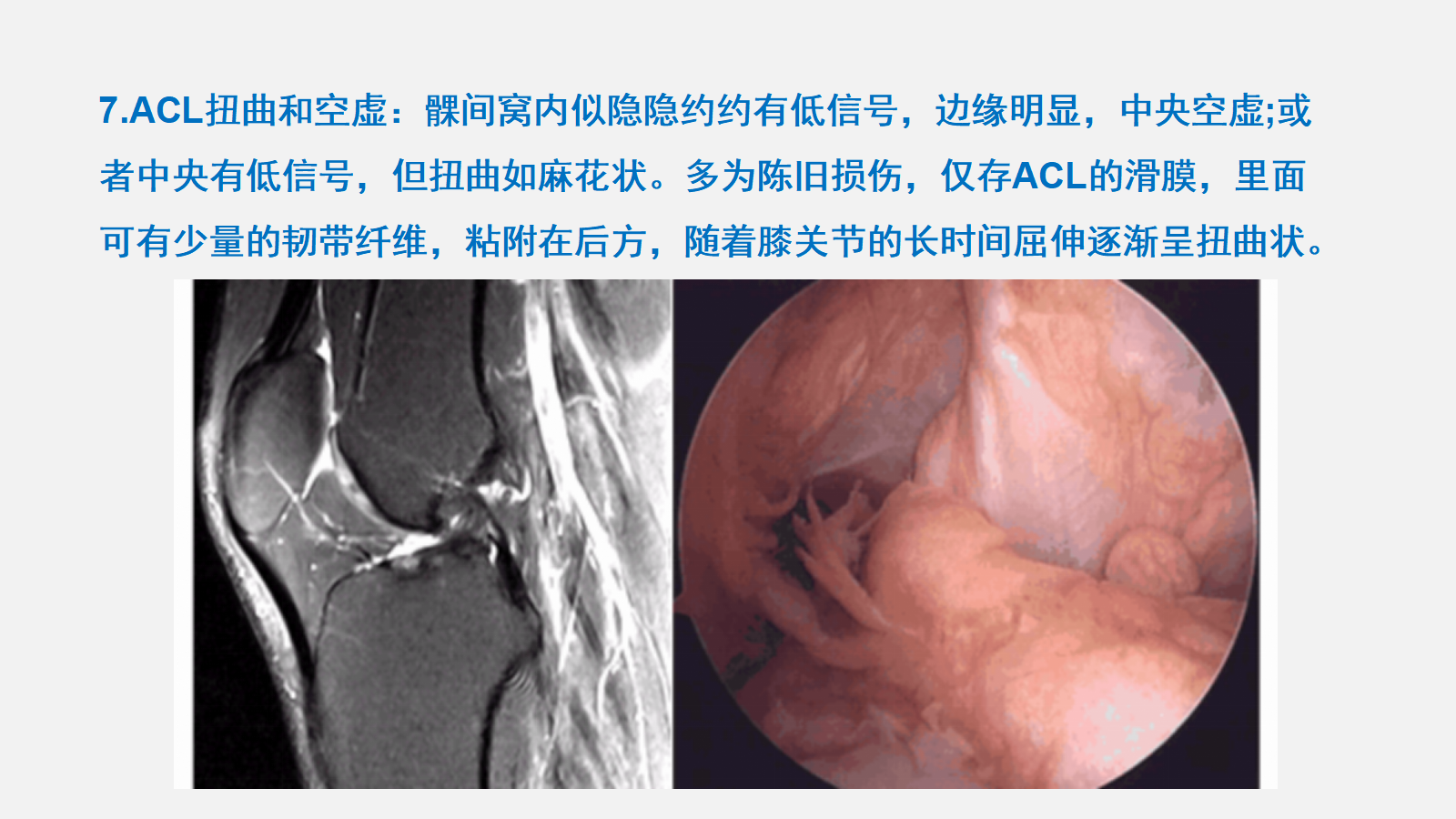 前交叉韧带（ACL）损伤的MRI诊断技巧，详细解析！