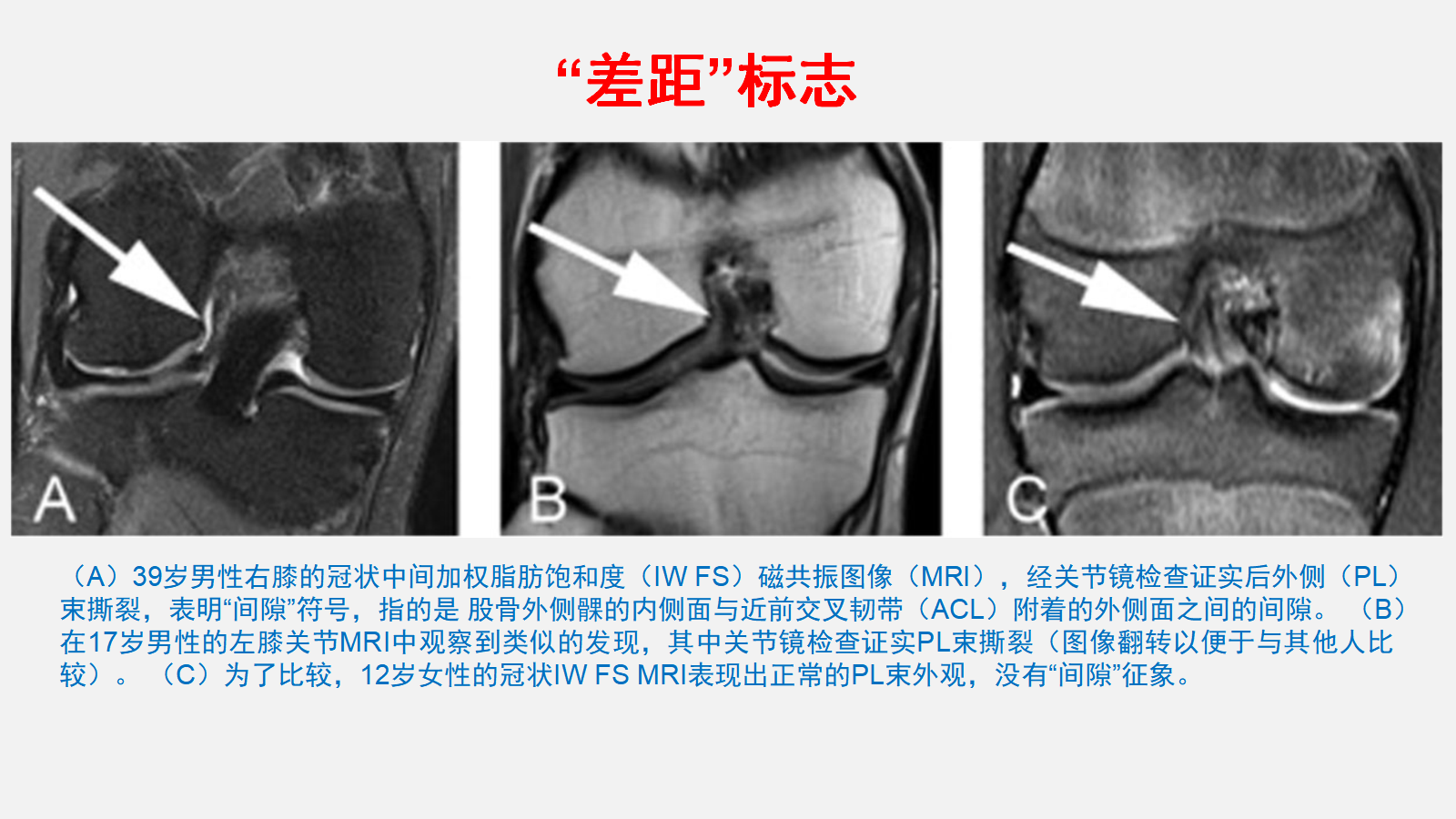 前交叉韧带（ACL）损伤的MRI诊断技巧，详细解析！