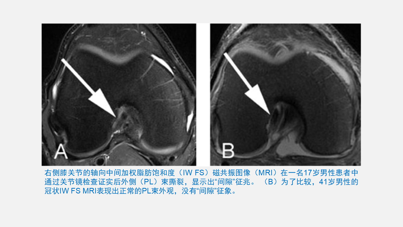 前交叉韧带（ACL）损伤的MRI诊断技巧，详细解析！