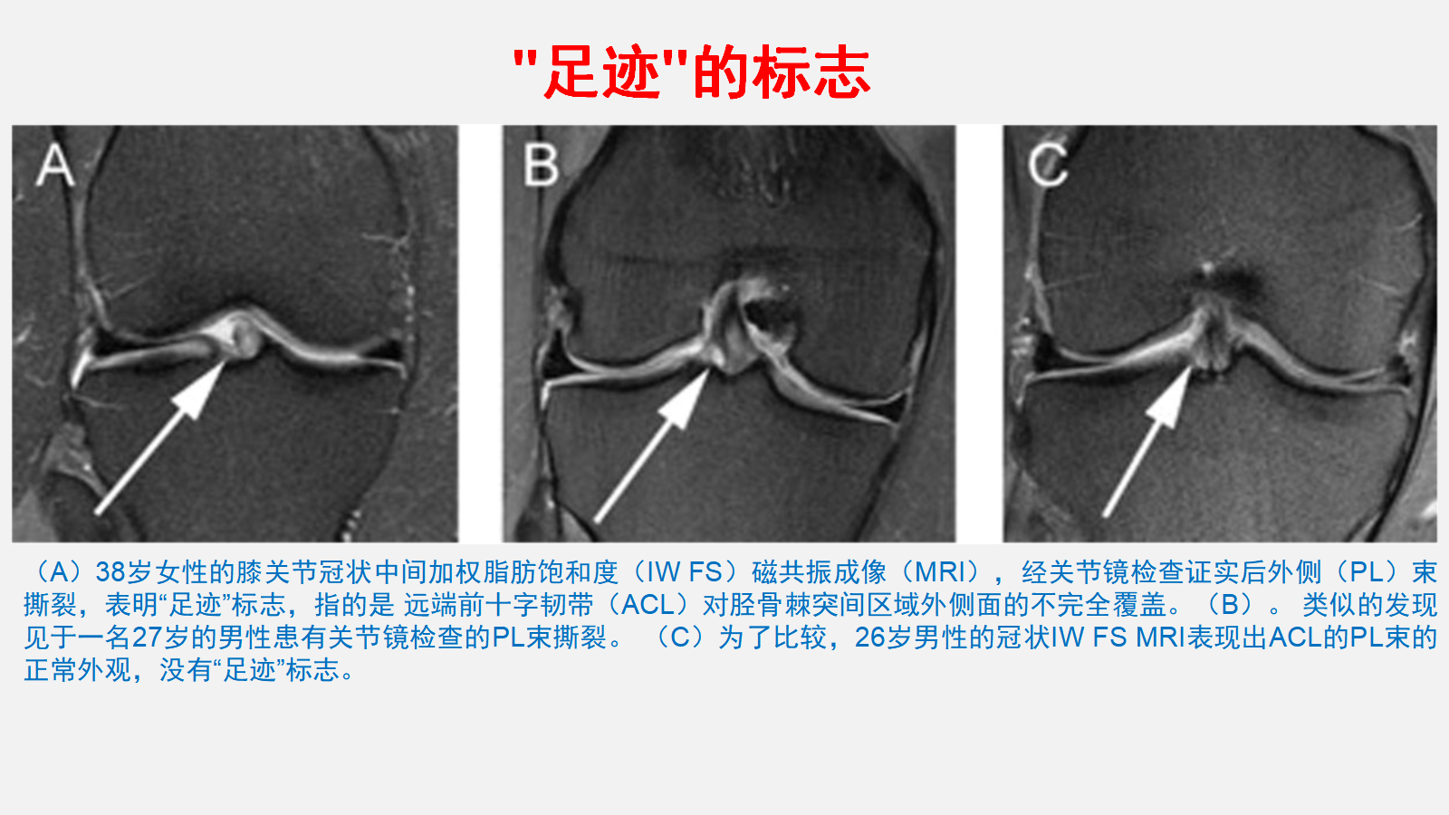 前交叉韧带（ACL）损伤的MRI诊断技巧，详细解析！