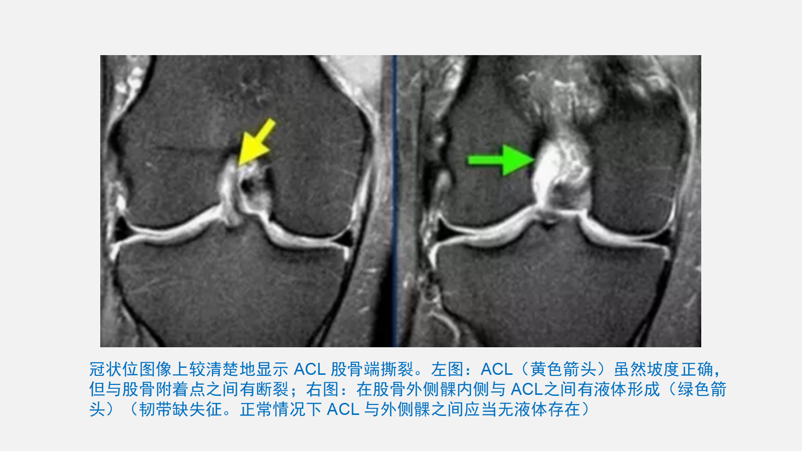 前交叉韧带（ACL）损伤的MRI诊断技巧，详细解析！