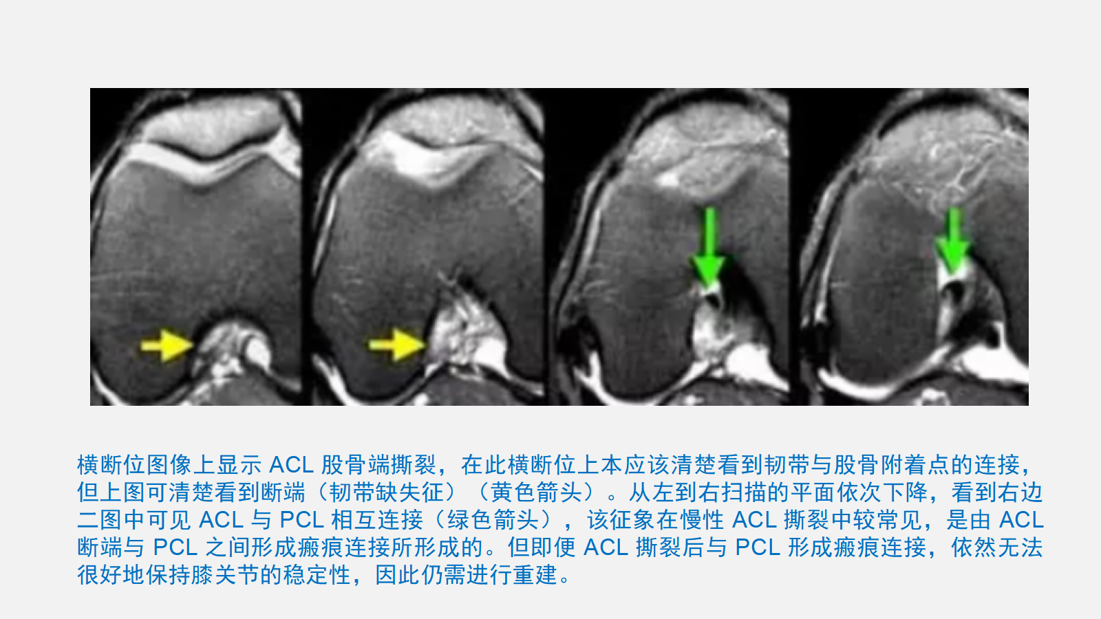 前交叉韧带（ACL）损伤的MRI诊断技巧，详细解析！