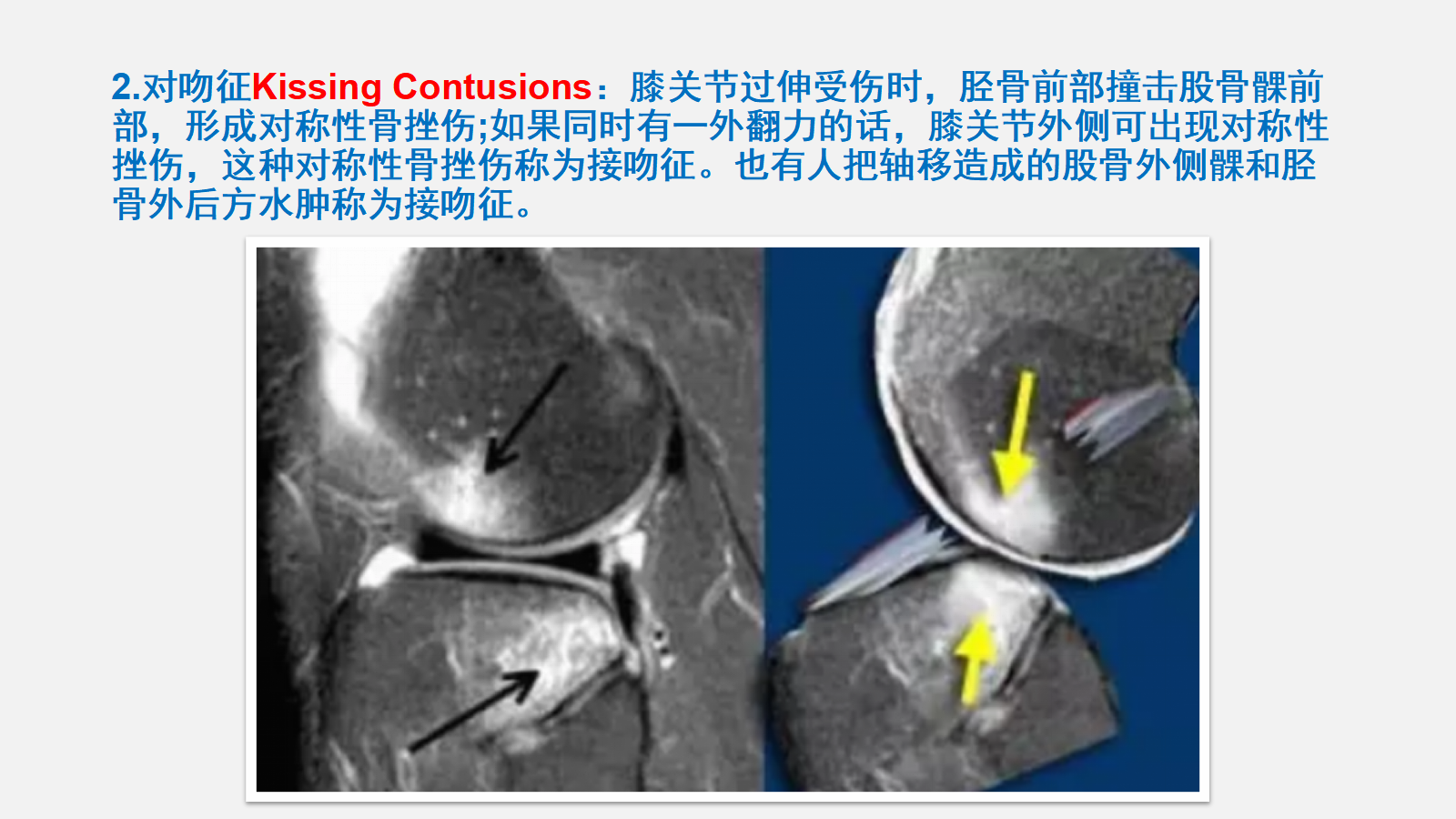 前交叉韧带（ACL）损伤的MRI诊断技巧，详细解析！