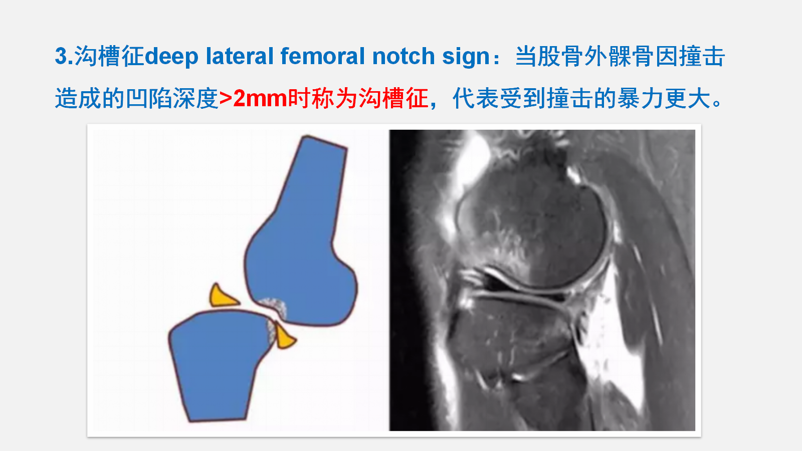 前交叉韧带（ACL）损伤的MRI诊断技巧，详细解析！