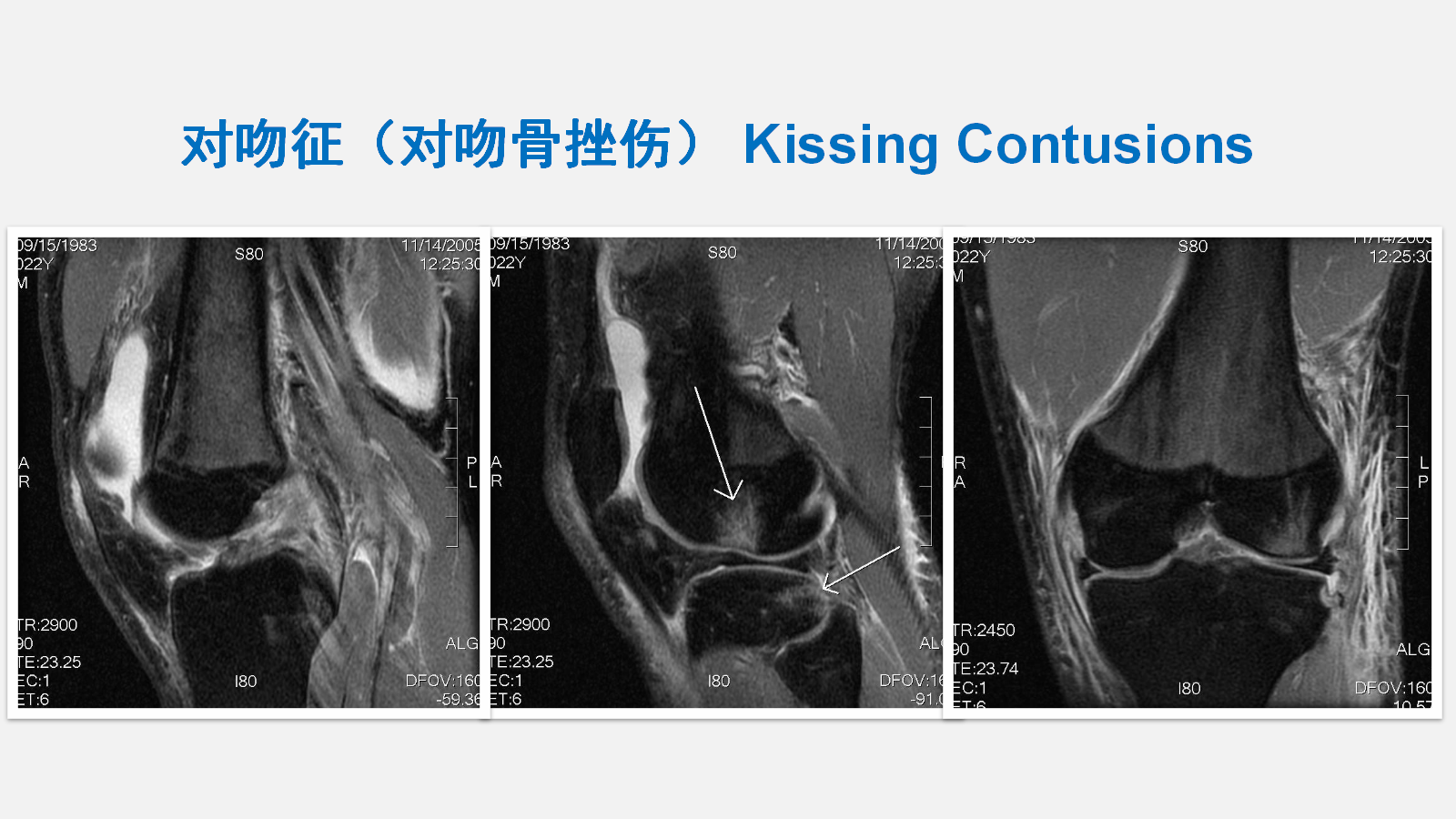 前交叉韧带（ACL）损伤的MRI诊断技巧，详细解析！