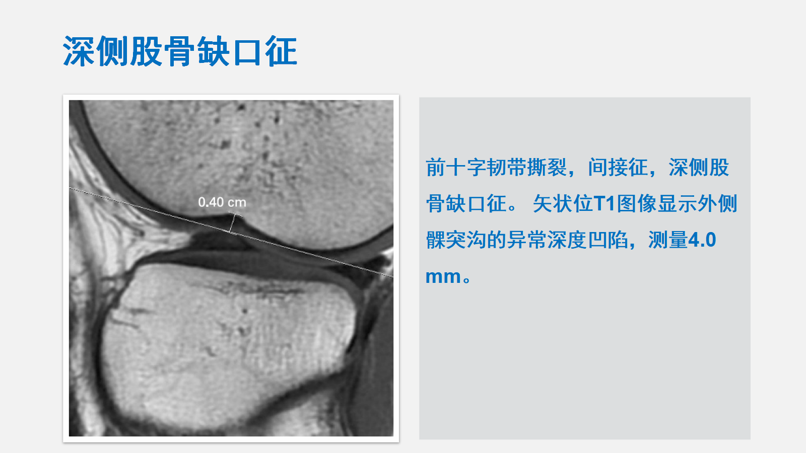 前交叉韧带（ACL）损伤的MRI诊断技巧，详细解析！