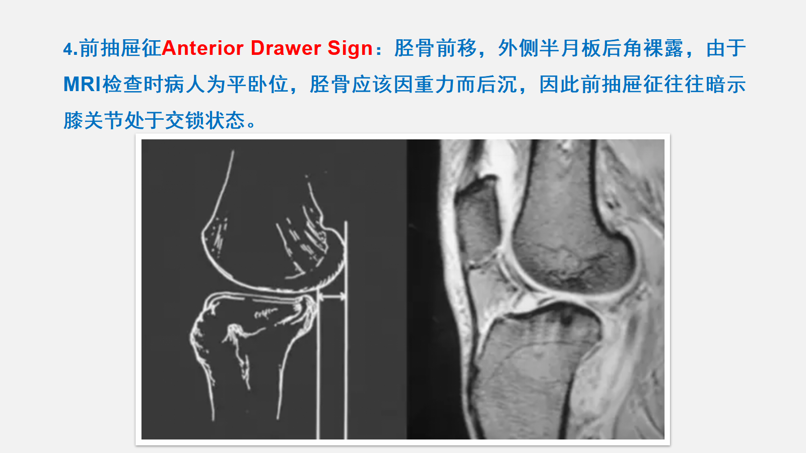 前交叉韧带（ACL）损伤的MRI诊断技巧，详细解析！