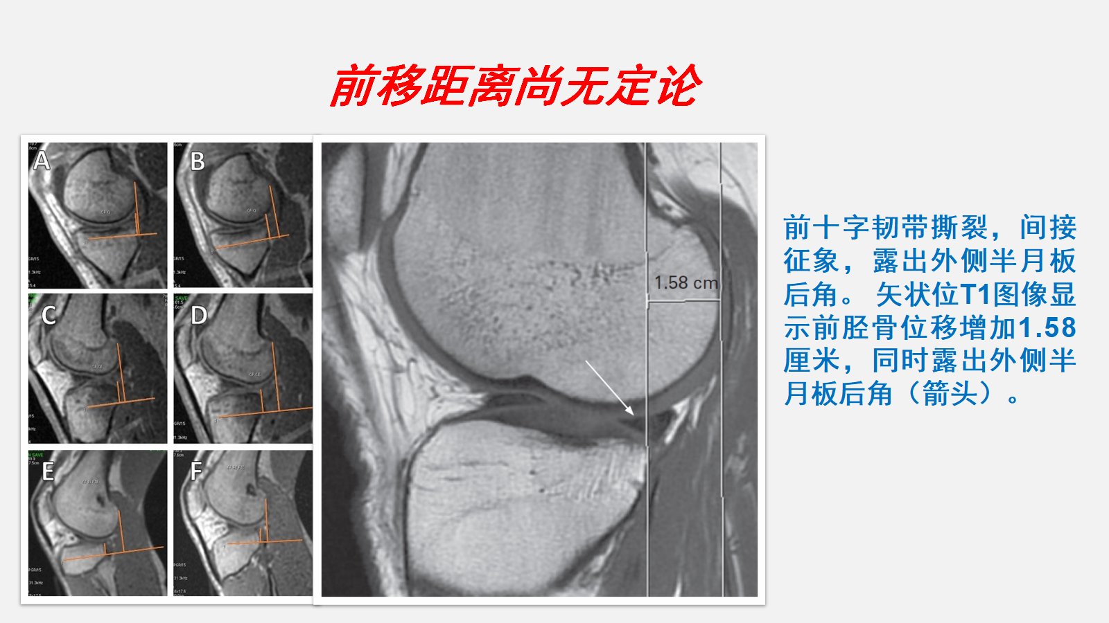 前交叉韧带（ACL）损伤的MRI诊断技巧，详细解析！