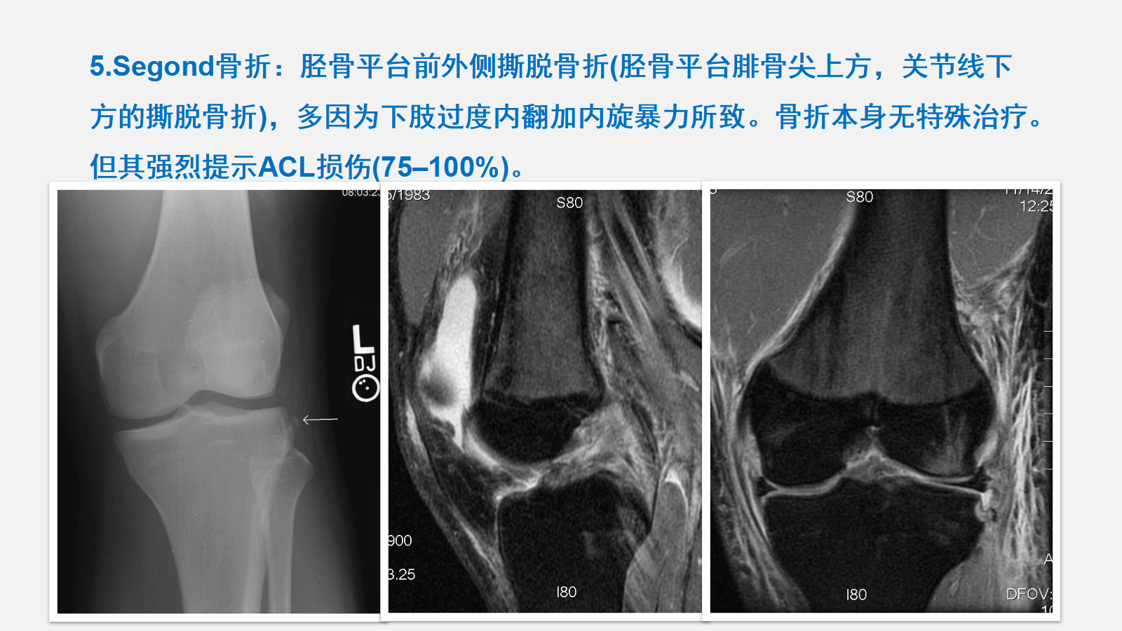 前交叉韧带（ACL）损伤的MRI诊断技巧，详细解析！