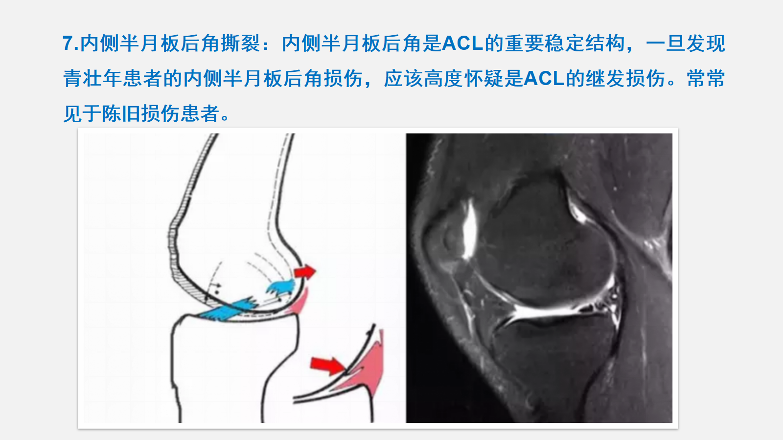 前交叉韧带（ACL）损伤的MRI诊断技巧，详细解析！