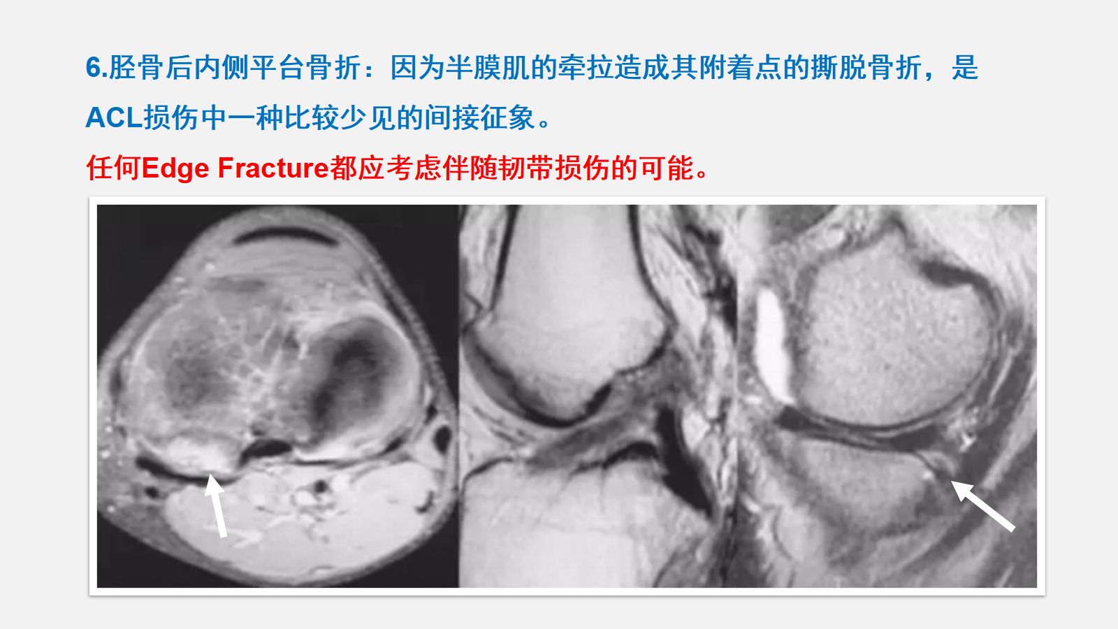 前交叉韧带（ACL）损伤的MRI诊断技巧，详细解析！