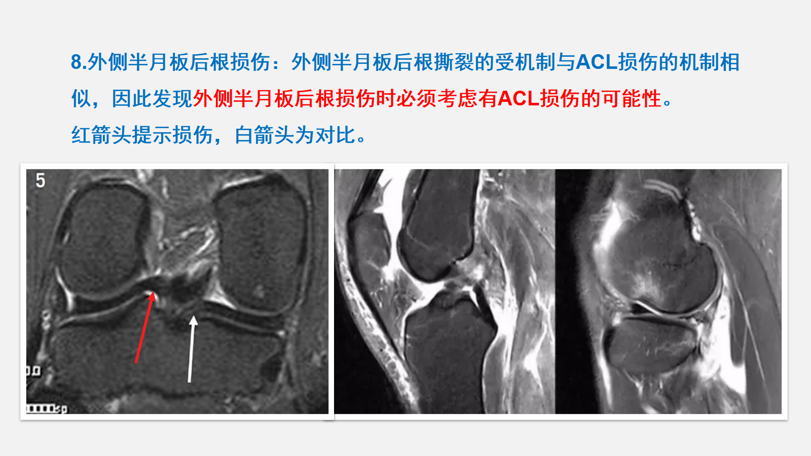 前交叉韧带（ACL）损伤的MRI诊断技巧，详细解析！