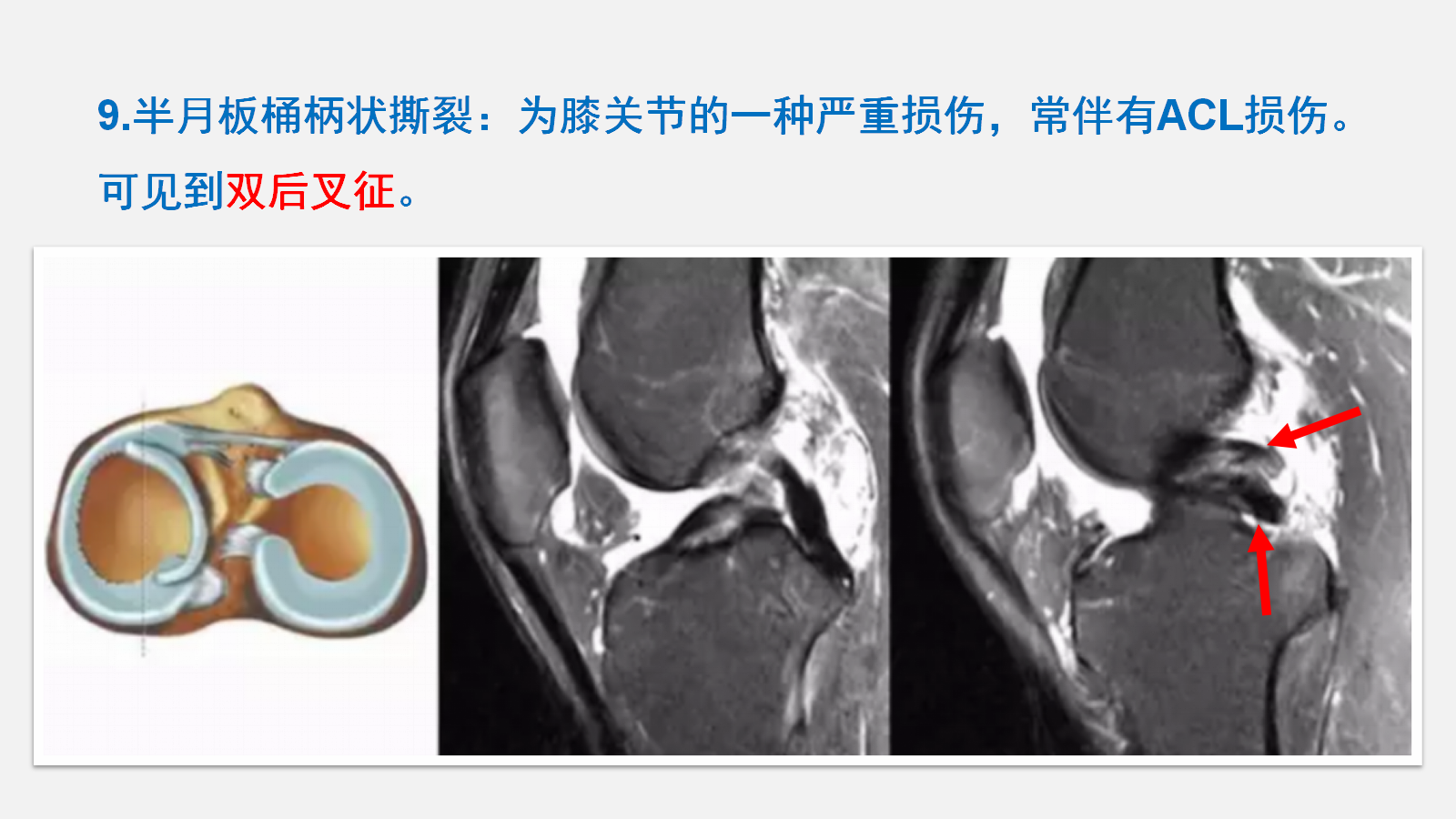 前交叉韧带（ACL）损伤的MRI诊断技巧，详细解析！