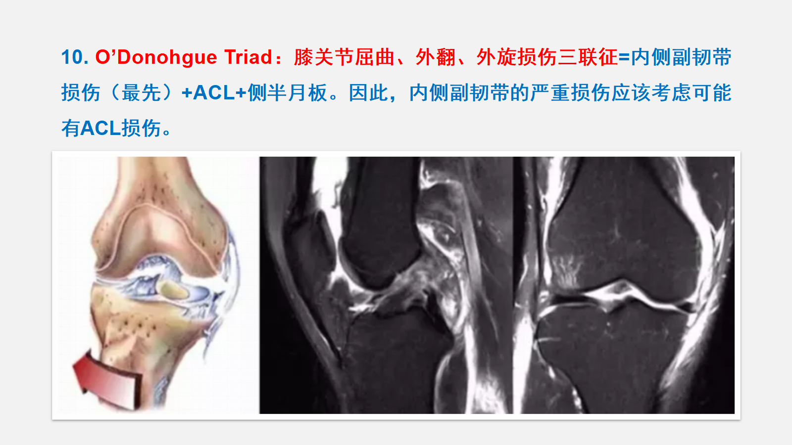 前交叉韧带（ACL）损伤的MRI诊断技巧，详细解析！