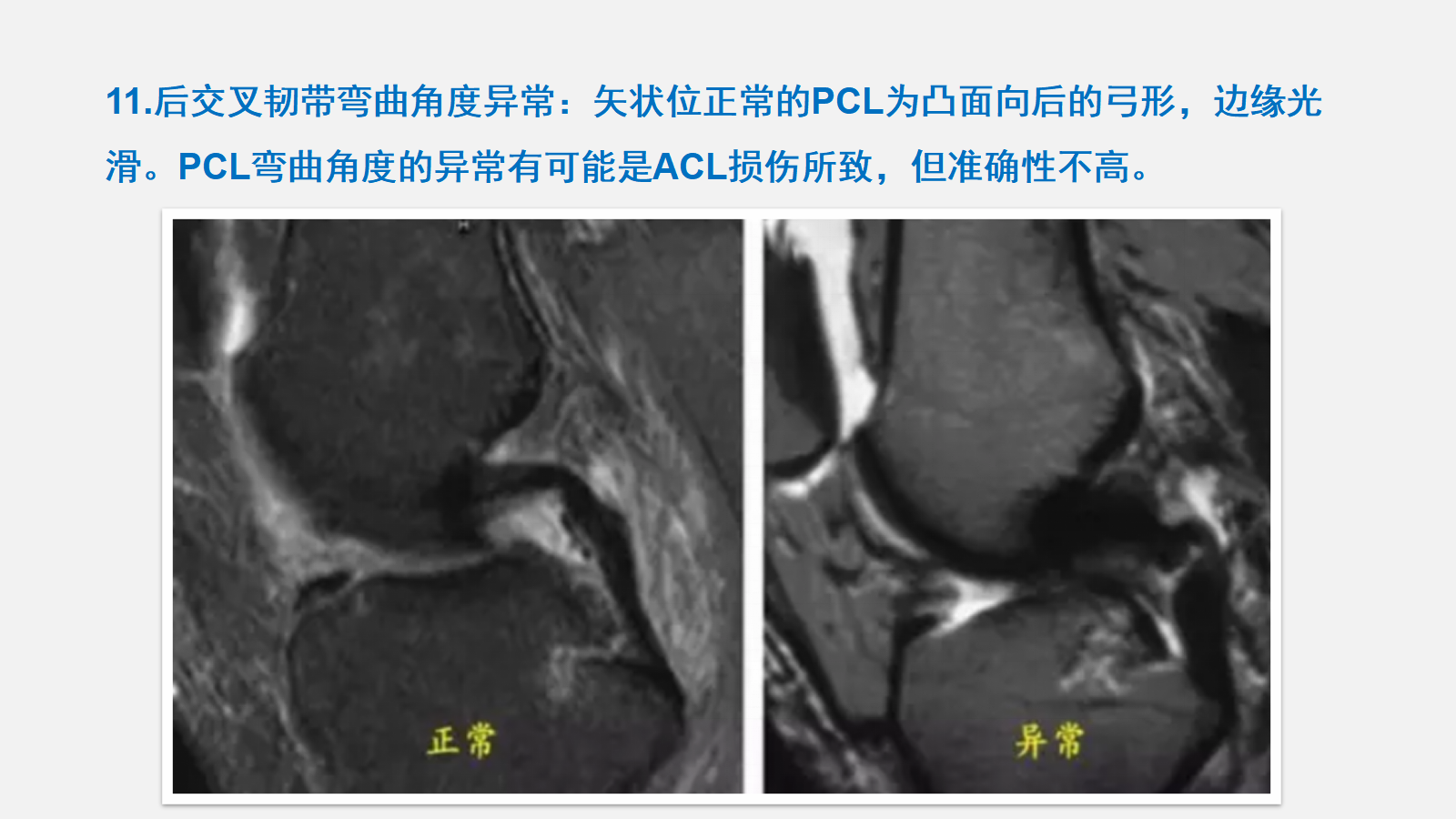 前交叉韧带（ACL）损伤的MRI诊断技巧，详细解析！