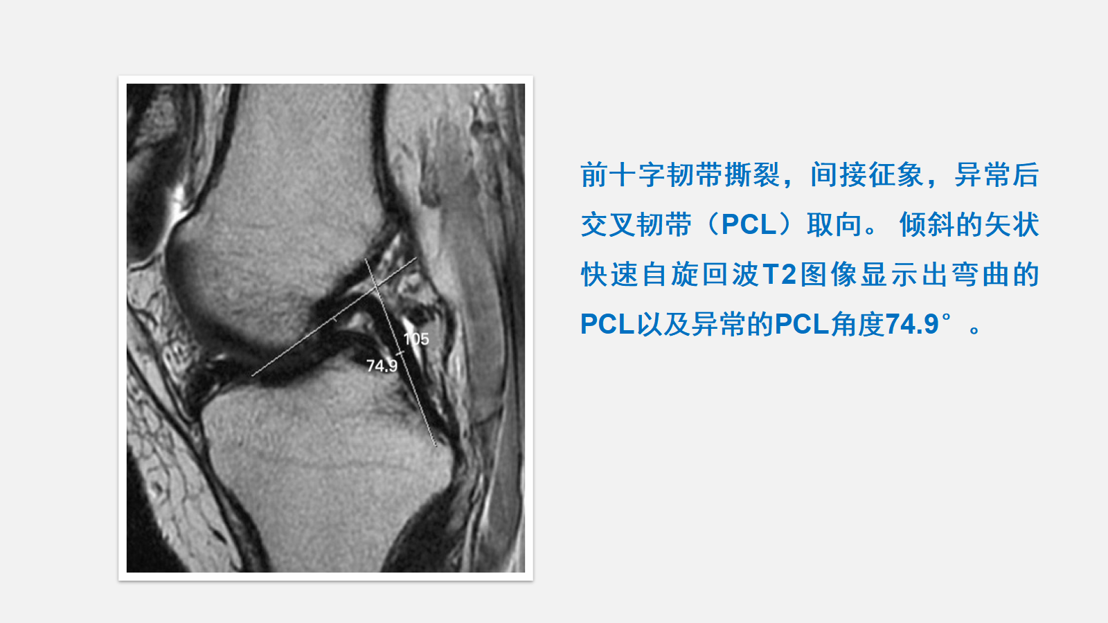 前交叉韧带（ACL）损伤的MRI诊断技巧，详细解析！