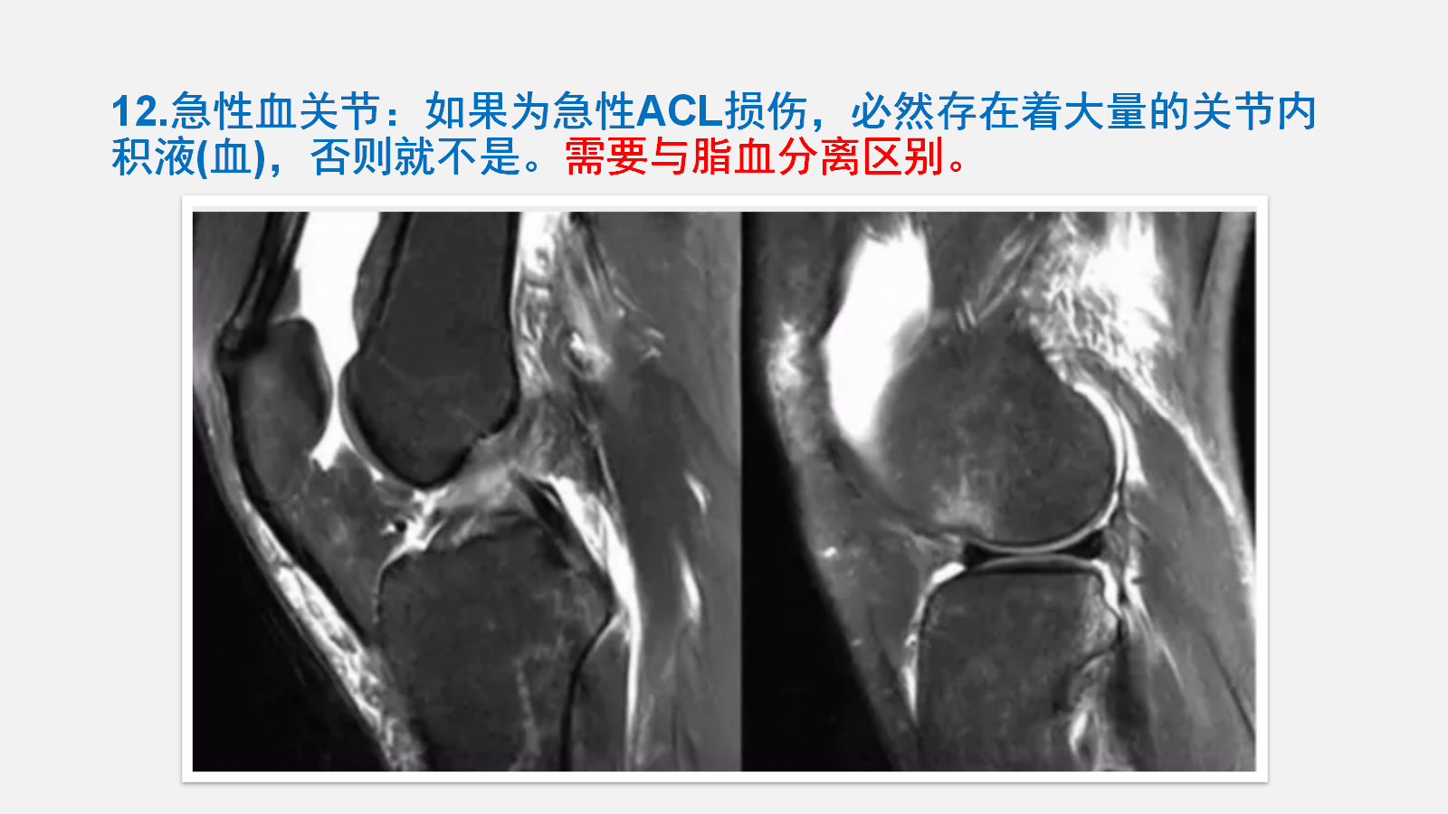 前交叉韧带（ACL）损伤的MRI诊断技巧，详细解析！