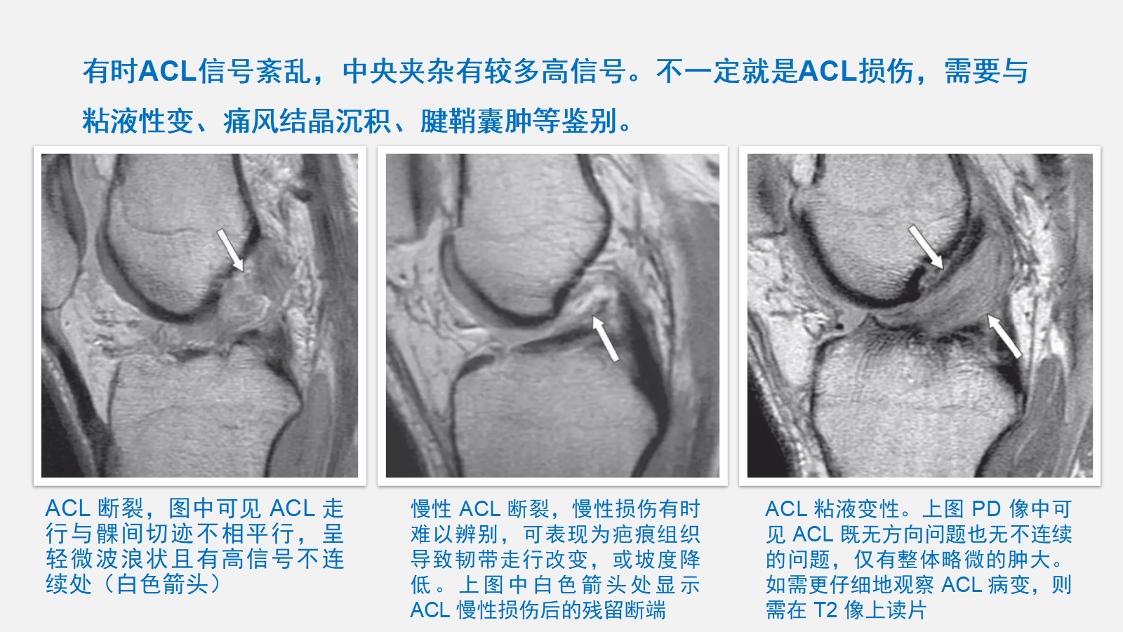 前交叉韧带（ACL）损伤的MRI诊断技巧，详细解析！