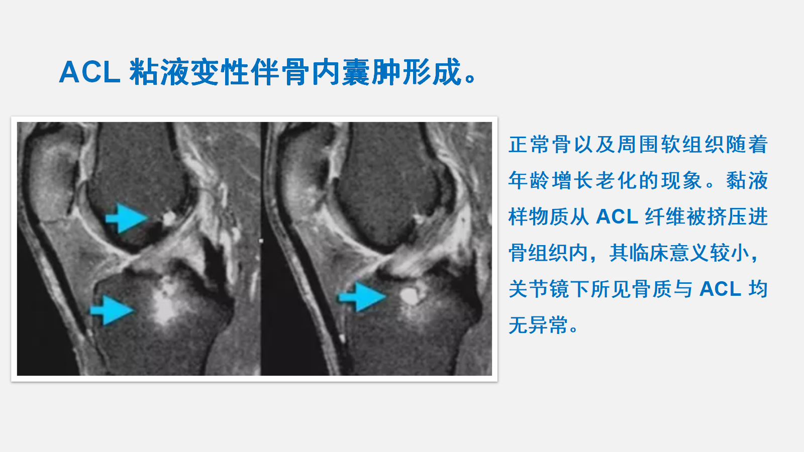 前交叉韧带（ACL）损伤的MRI诊断技巧，详细解析！