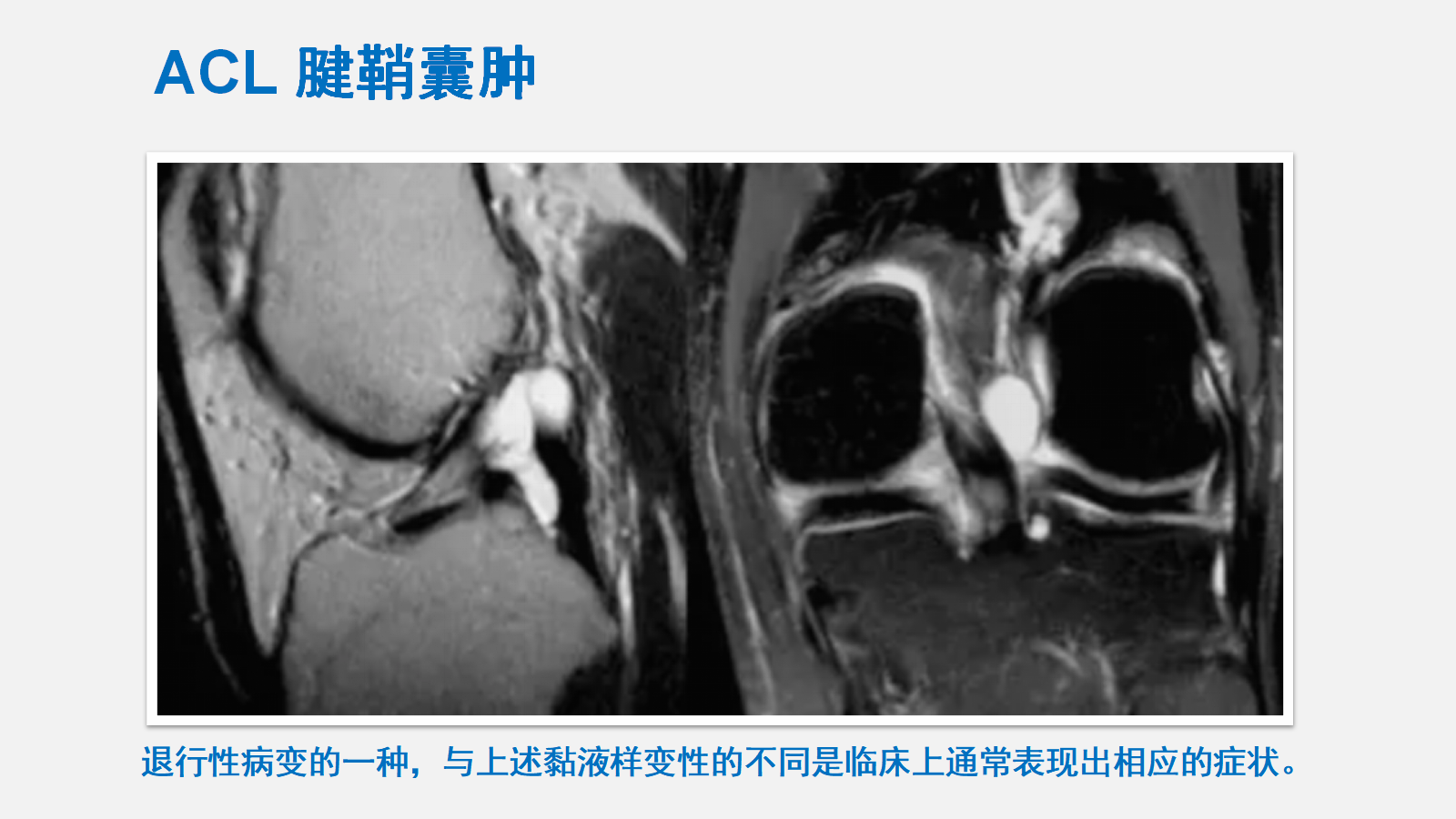 前交叉韧带（ACL）损伤的MRI诊断技巧，详细解析！