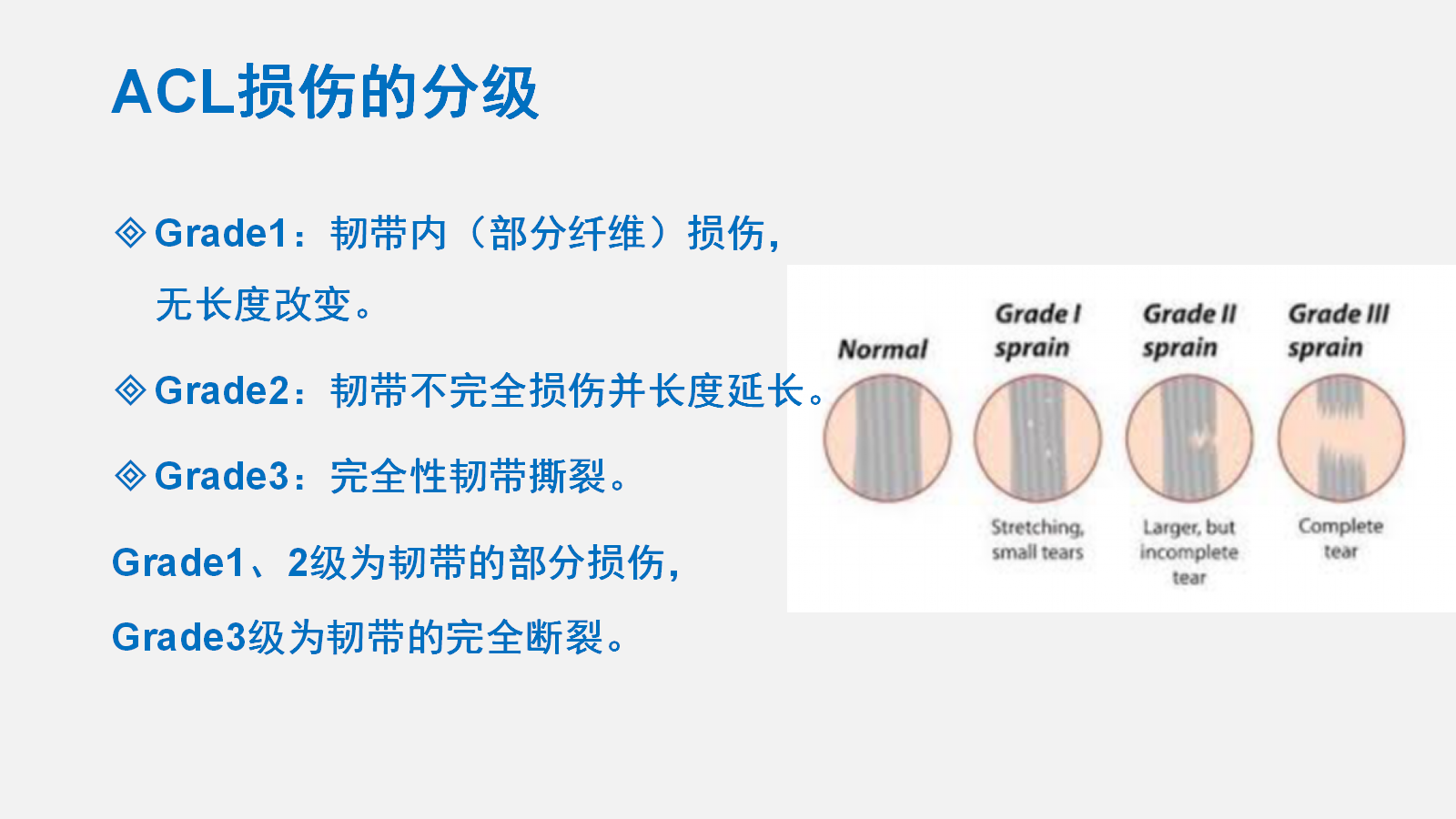 前交叉韧带（ACL）损伤的MRI诊断技巧，详细解析！