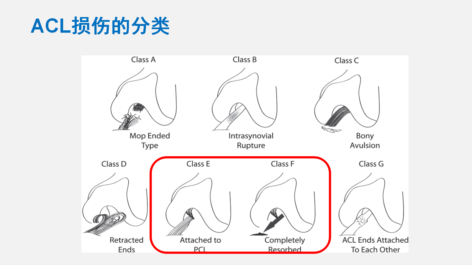 前交叉韧带（ACL）损伤的MRI诊断技巧，详细解析！