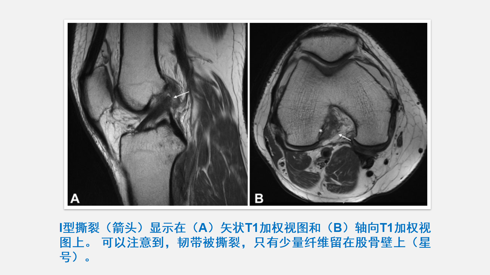 前交叉韧带（ACL）损伤的MRI诊断技巧，详细解析！