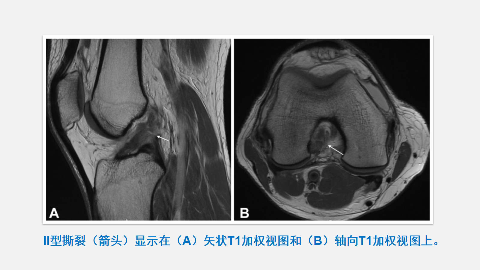 前交叉韧带（ACL）损伤的MRI诊断技巧，详细解析！