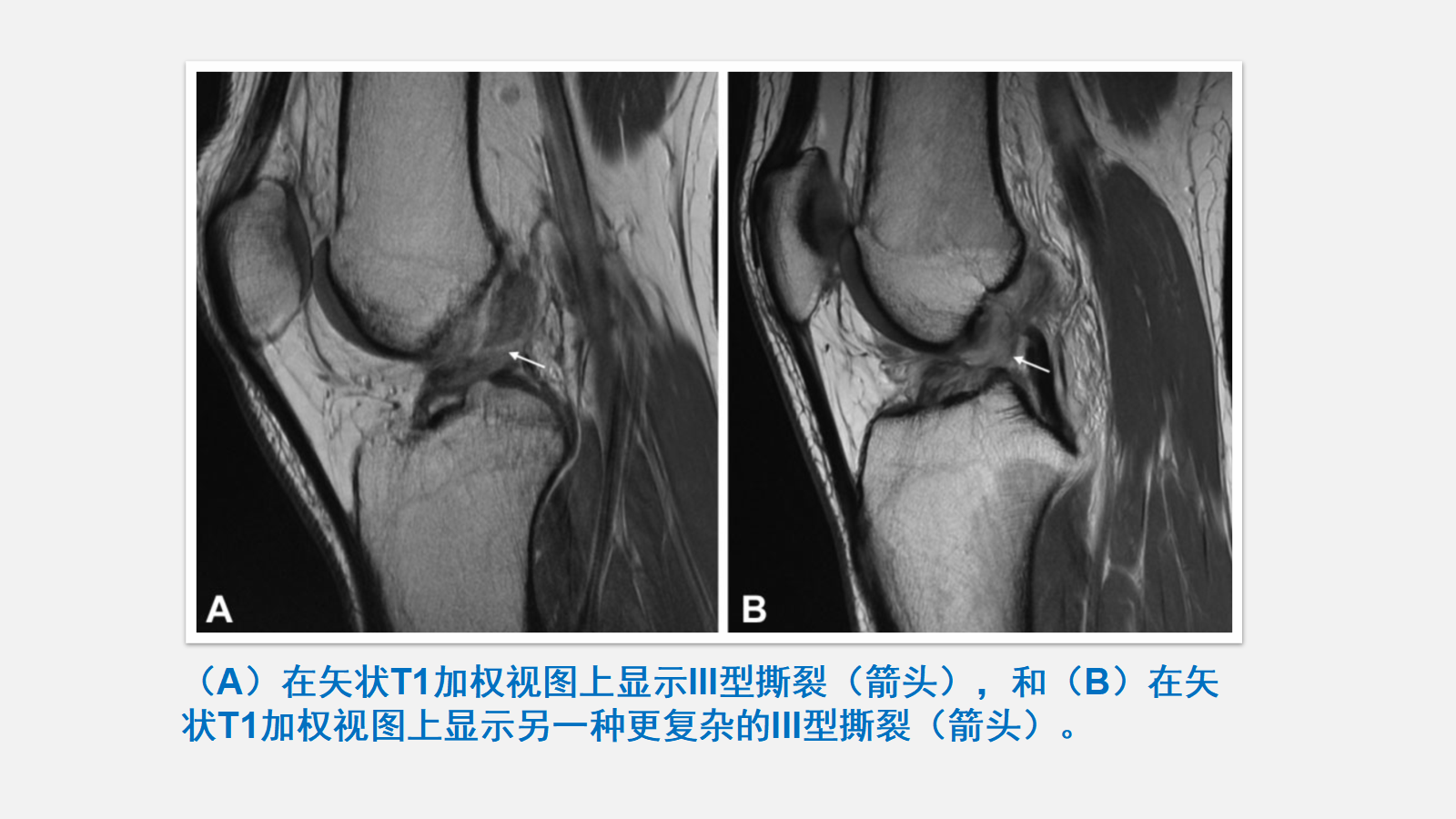 前交叉韧带（ACL）损伤的MRI诊断技巧，详细解析！