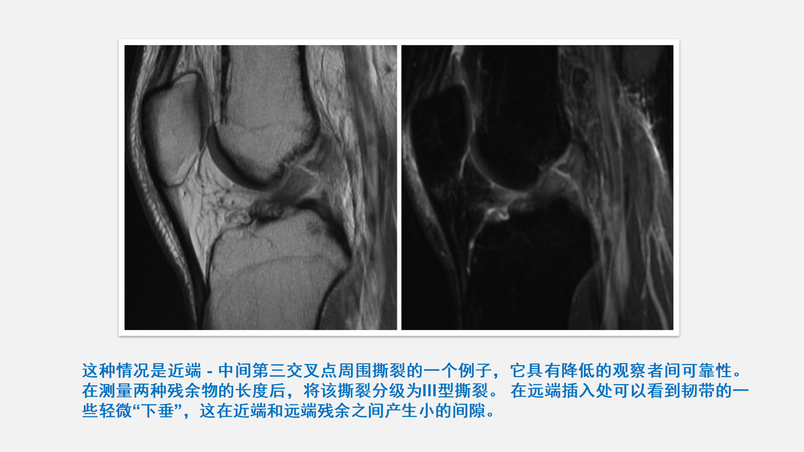 前交叉韧带（ACL）损伤的MRI诊断技巧，详细解析！