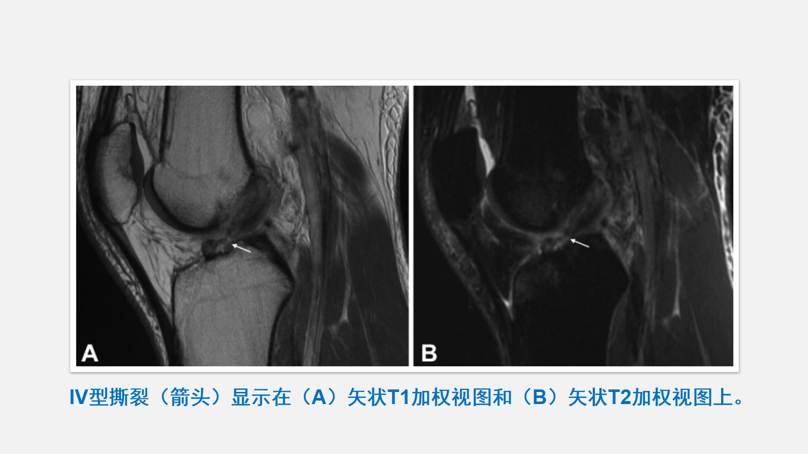 前交叉韧带（ACL）损伤的MRI诊断技巧，详细解析！