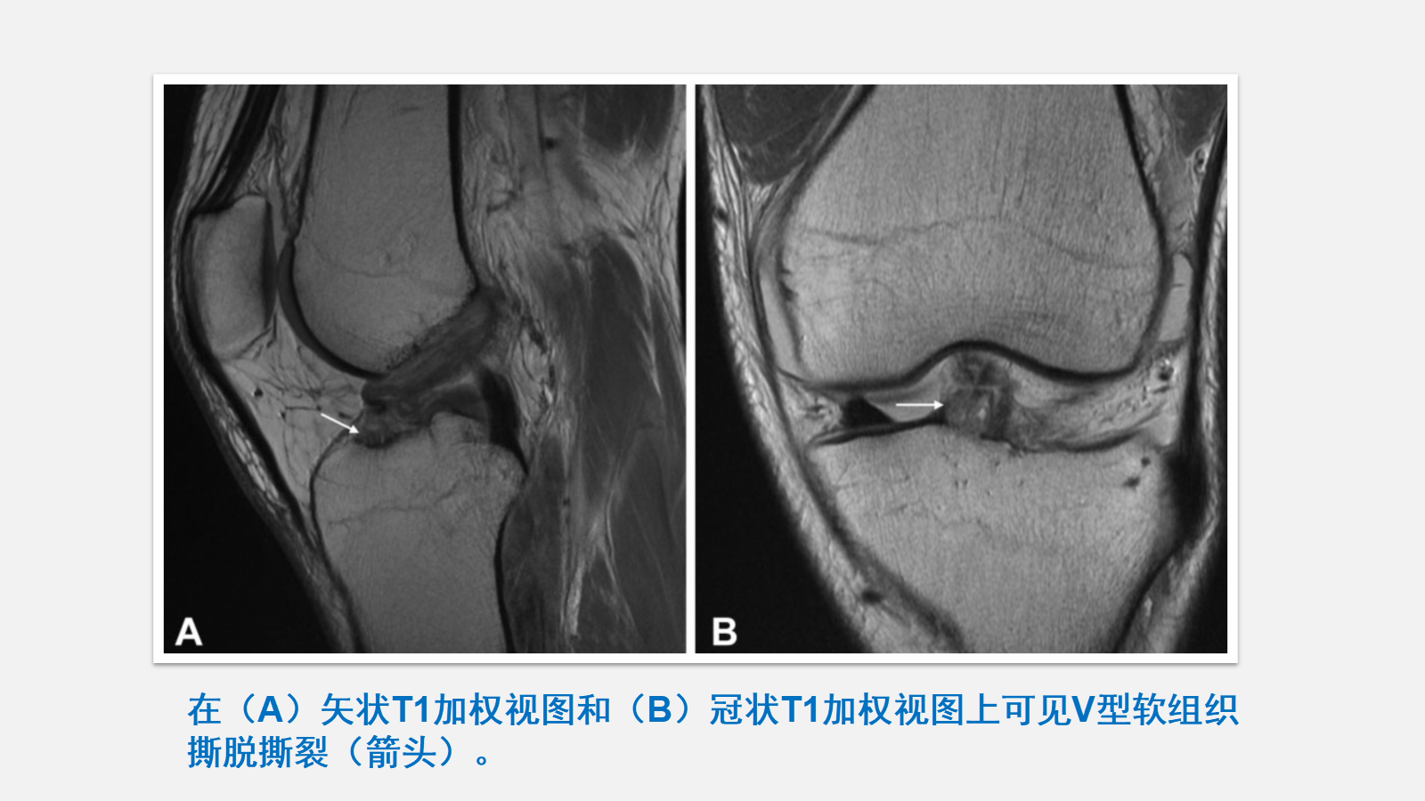 前交叉韧带（ACL）损伤的MRI诊断技巧，详细解析！