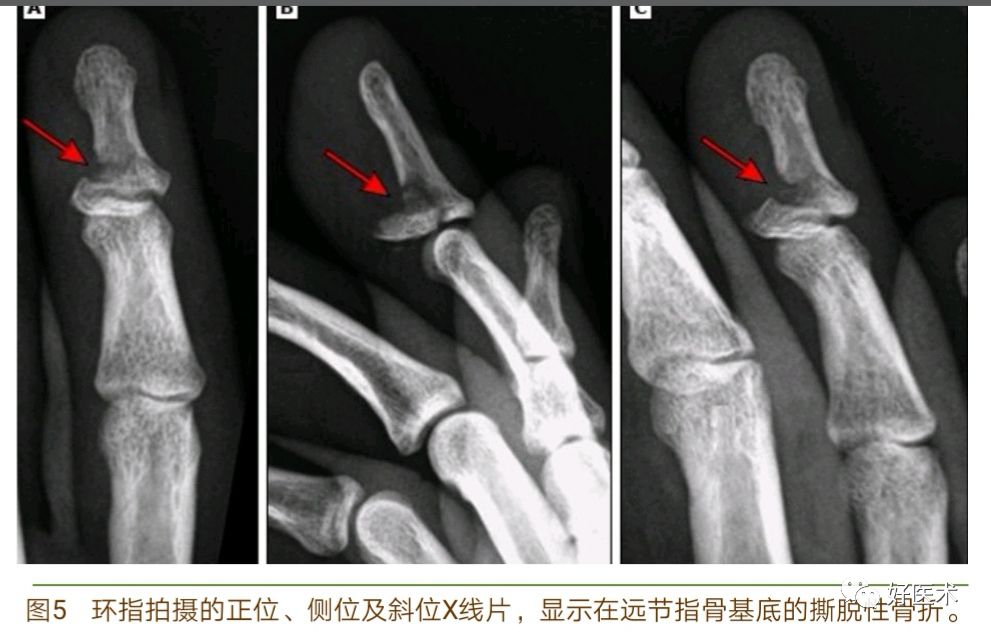 详解治疗球衣指的6种手术方法，你都掌握了吗？