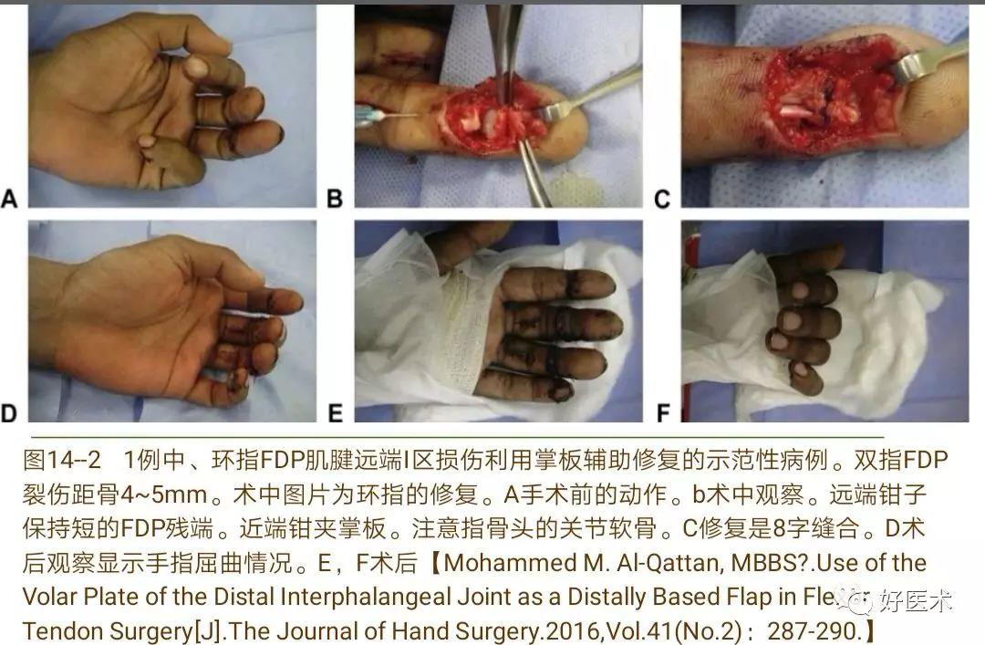 详解治疗球衣指的6种手术方法，你都掌握了吗？