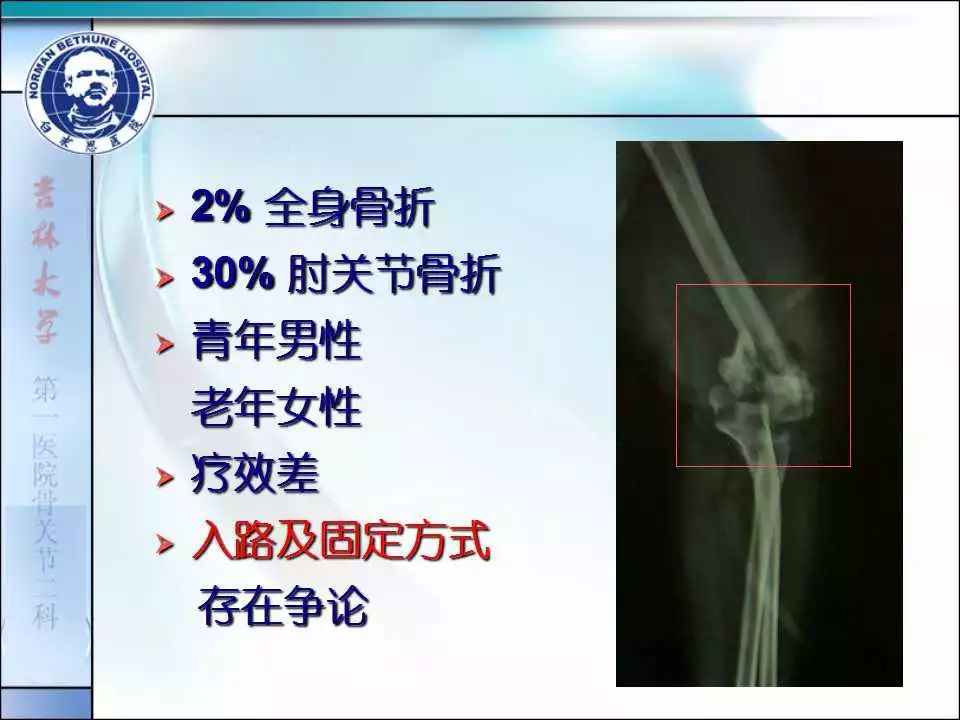 复杂肱骨远端关节内骨折手术入路及固定方式的选择