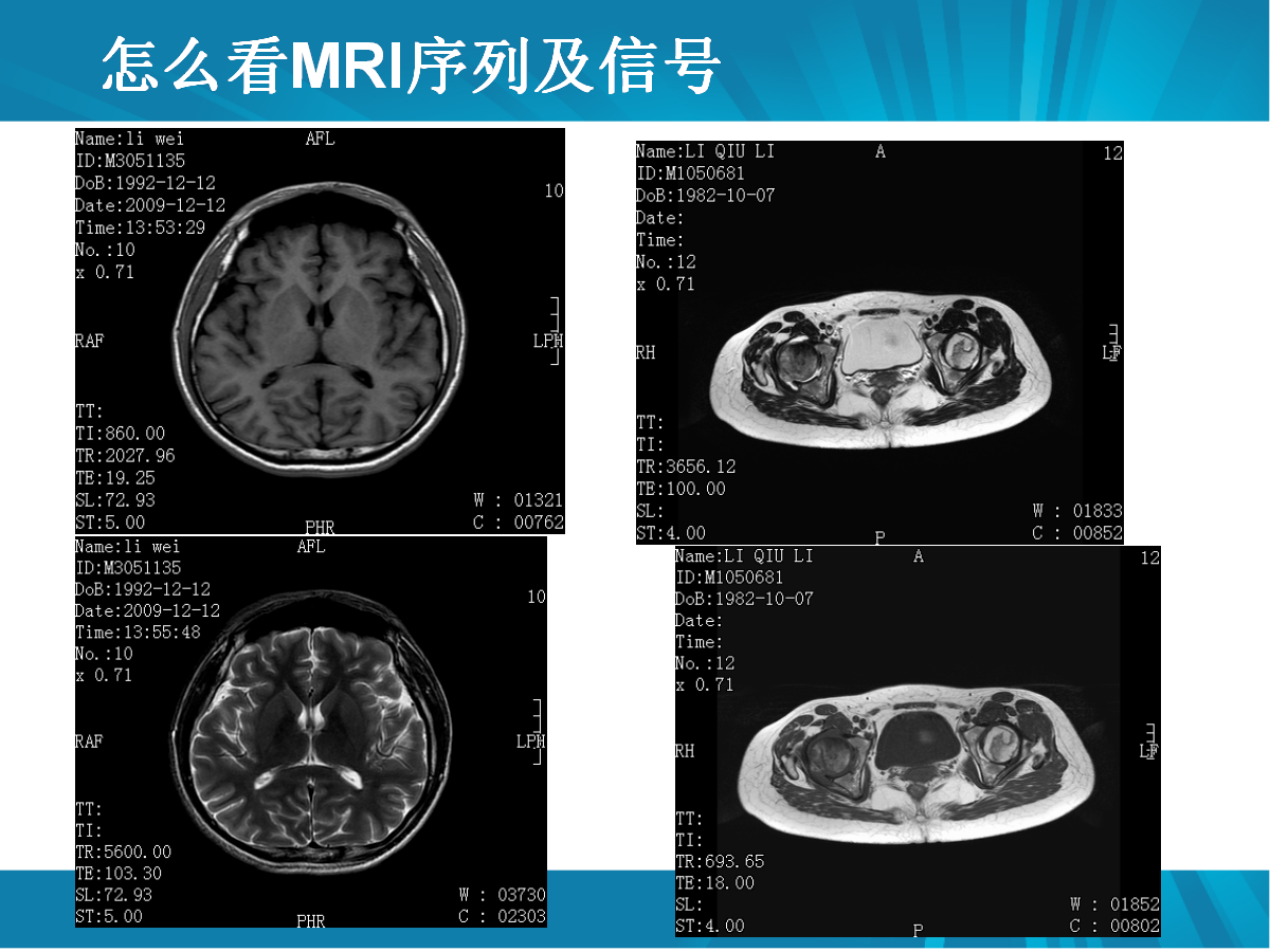 手把手教你如何阅读MRI片，太实用了！