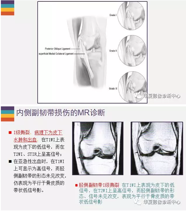 膝关节内侧副韧带损伤——详解！！！！