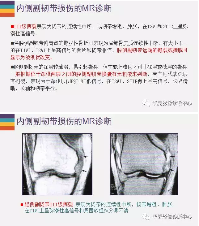 膝关节内侧副韧带损伤——详解！！！！