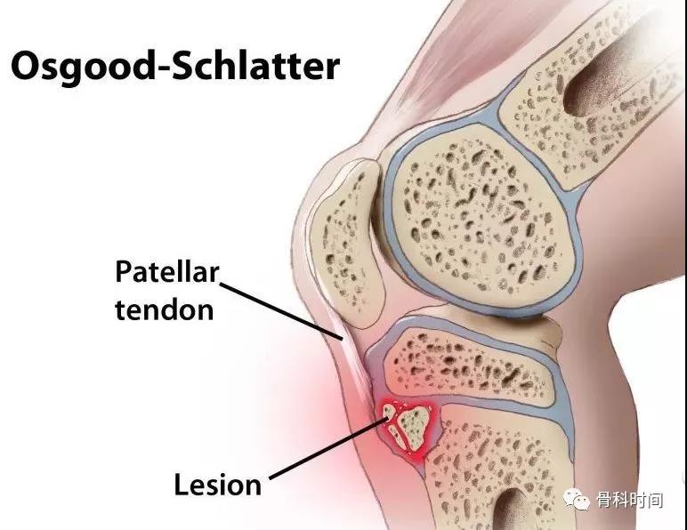 胫骨结节骨软骨炎的诊疗策略，看这篇！