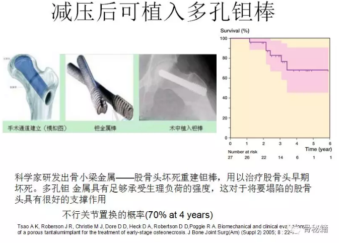 系统详解：股骨头坏死的手术治疗策略！