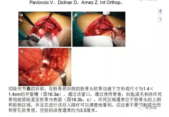 系统详解：股骨头坏死的手术治疗策略！