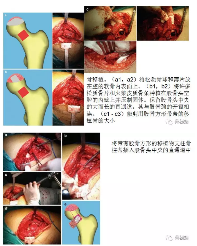 系统详解：股骨头坏死的手术治疗策略！