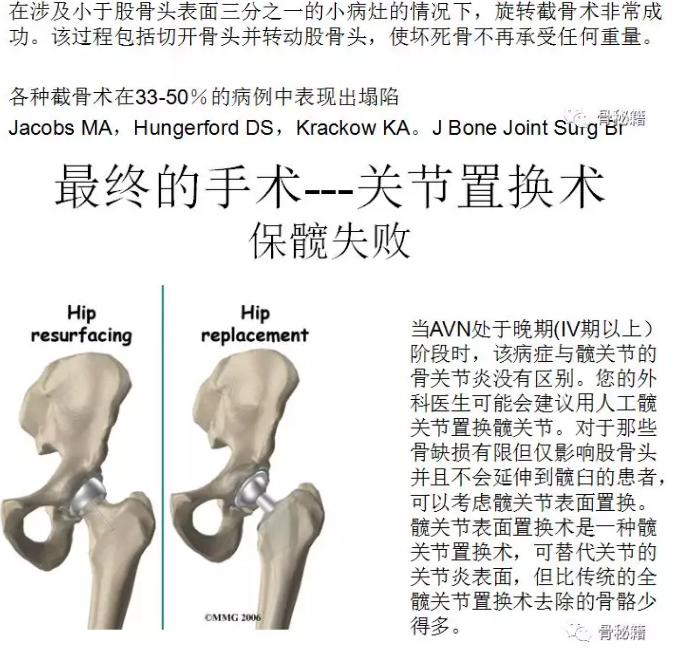 系统详解：股骨头坏死的手术治疗策略！