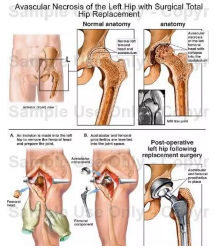 系统详解：股骨头坏死的手术治疗策略！